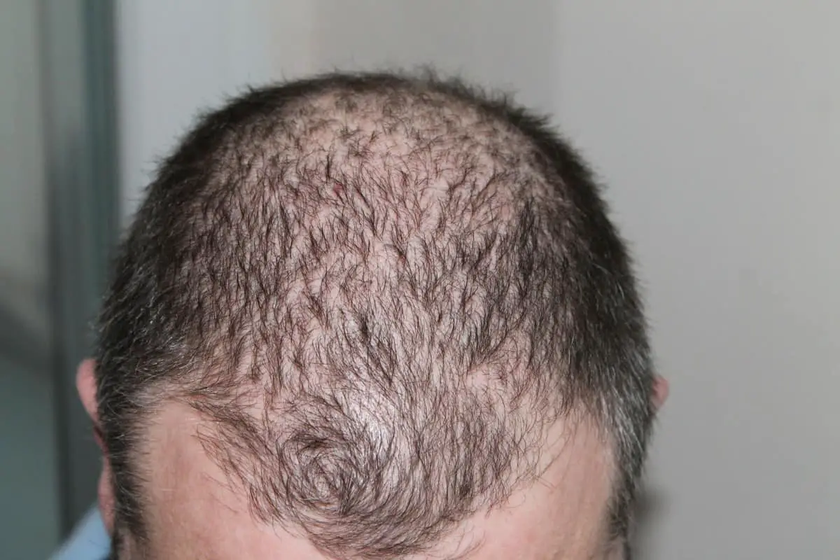 how to stop hormonal hair loss in male