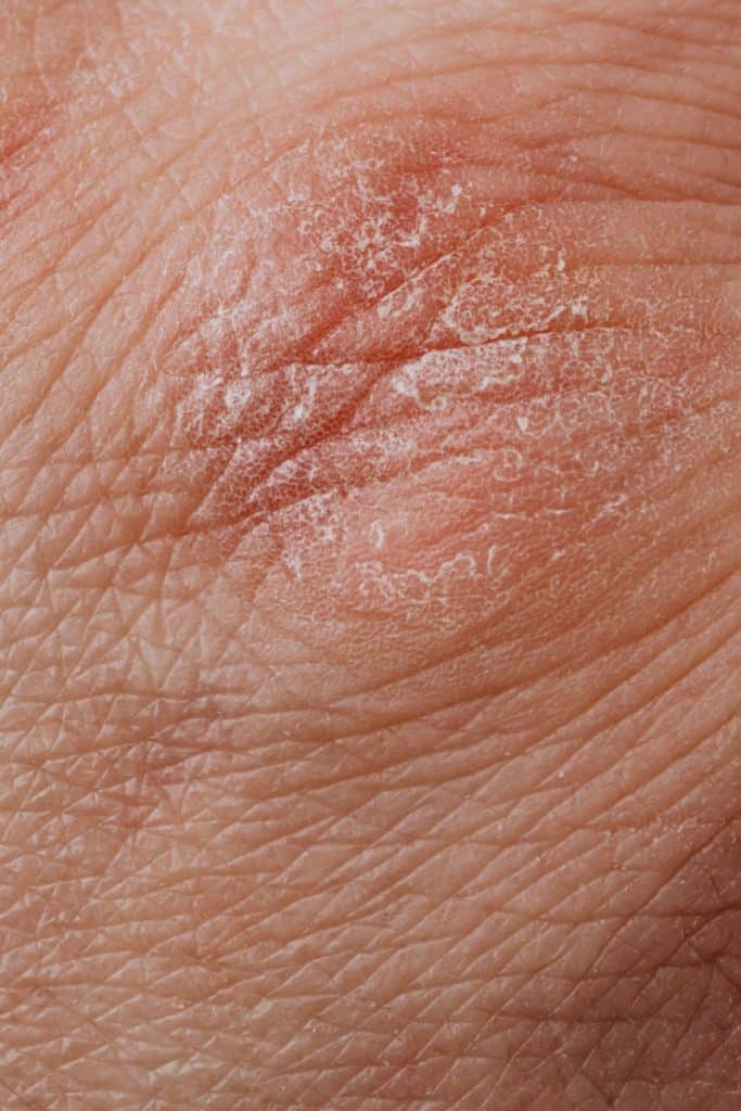 how often should you shower with eczema
